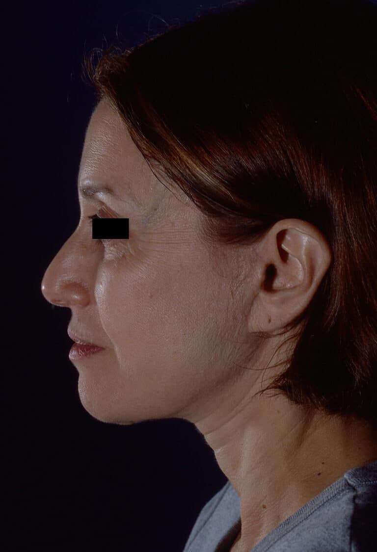 After Image: Facelift - left-side