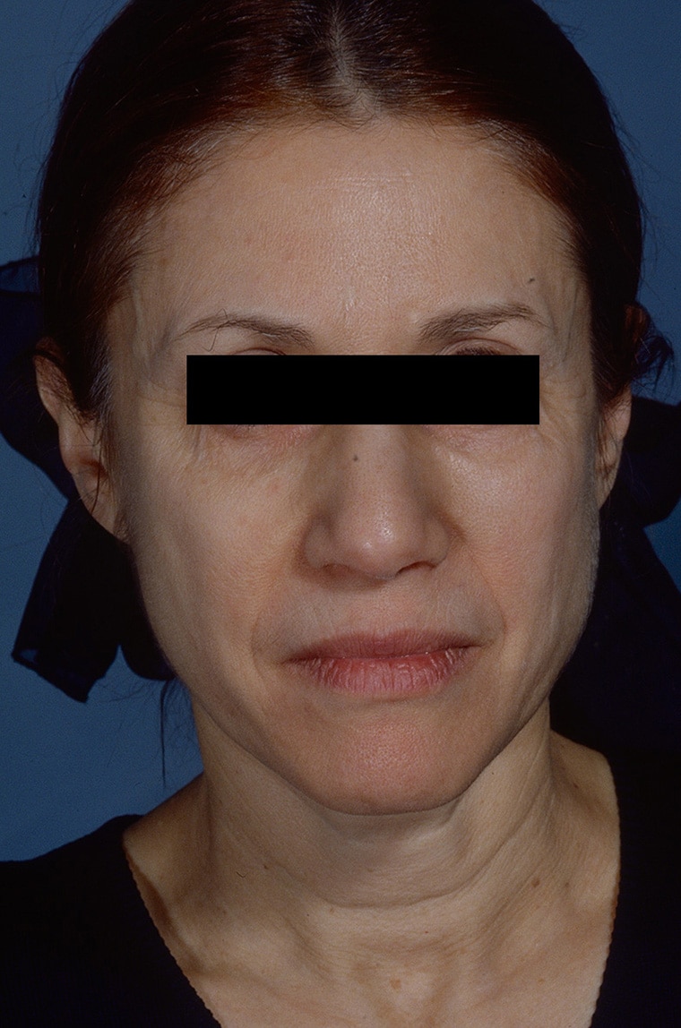 Before Image: Facelift - front