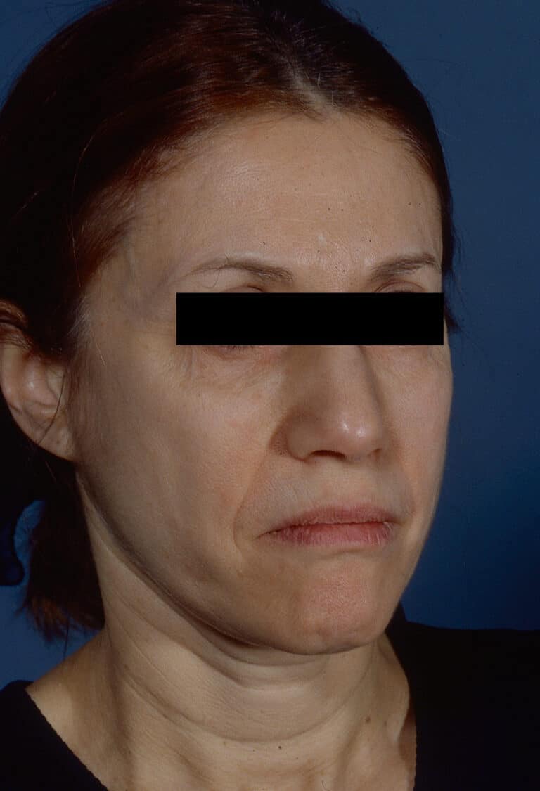Before Image: Facelift - right-front-oblique