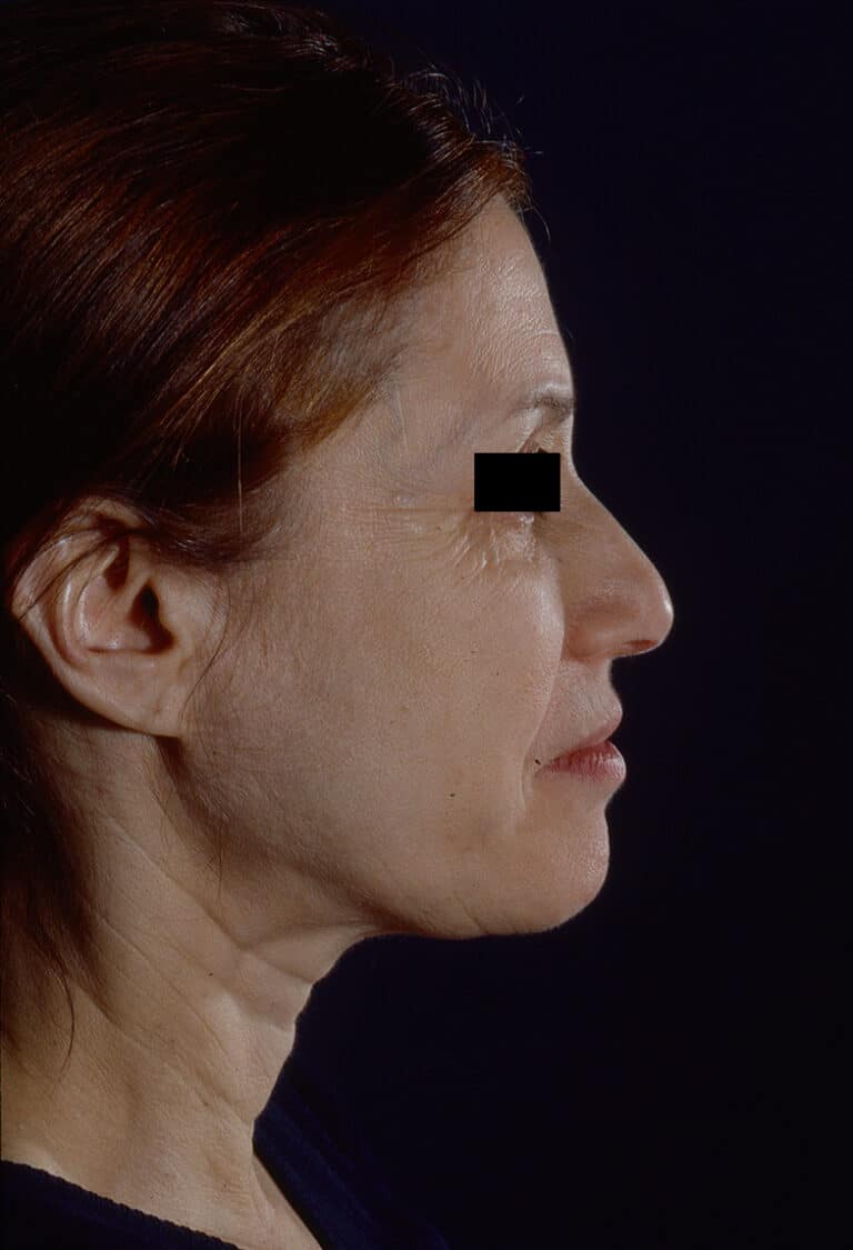 Before Image: Facelift - right-side