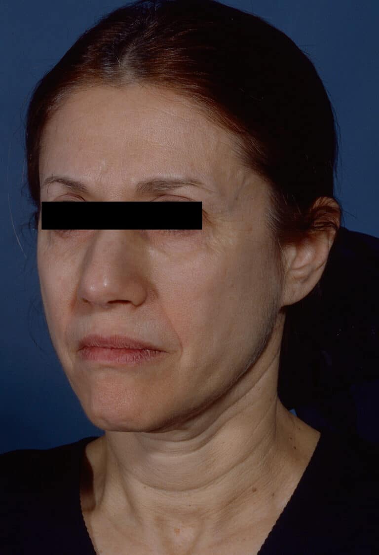 Before Image: Facelift - left-front-oblique