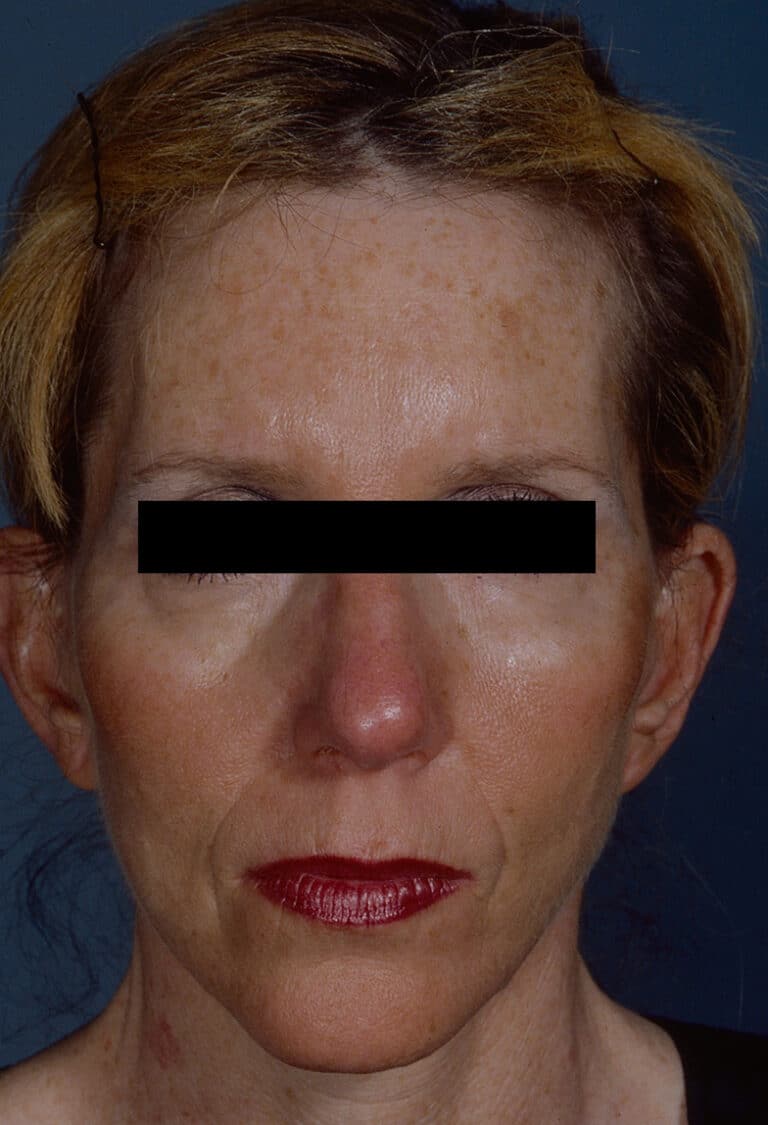 After Image: Facelift - front