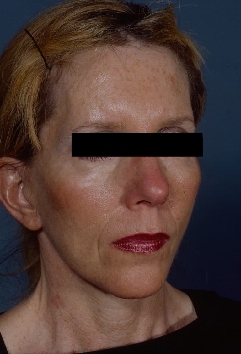 After Image: Facelift - right-front-oblique