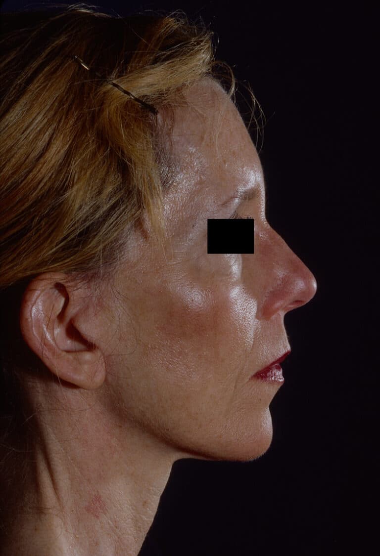 After Image: Facelift - right-side