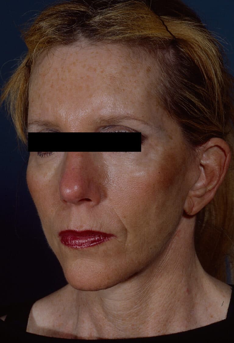 After Image: Facelift - left-front-oblique