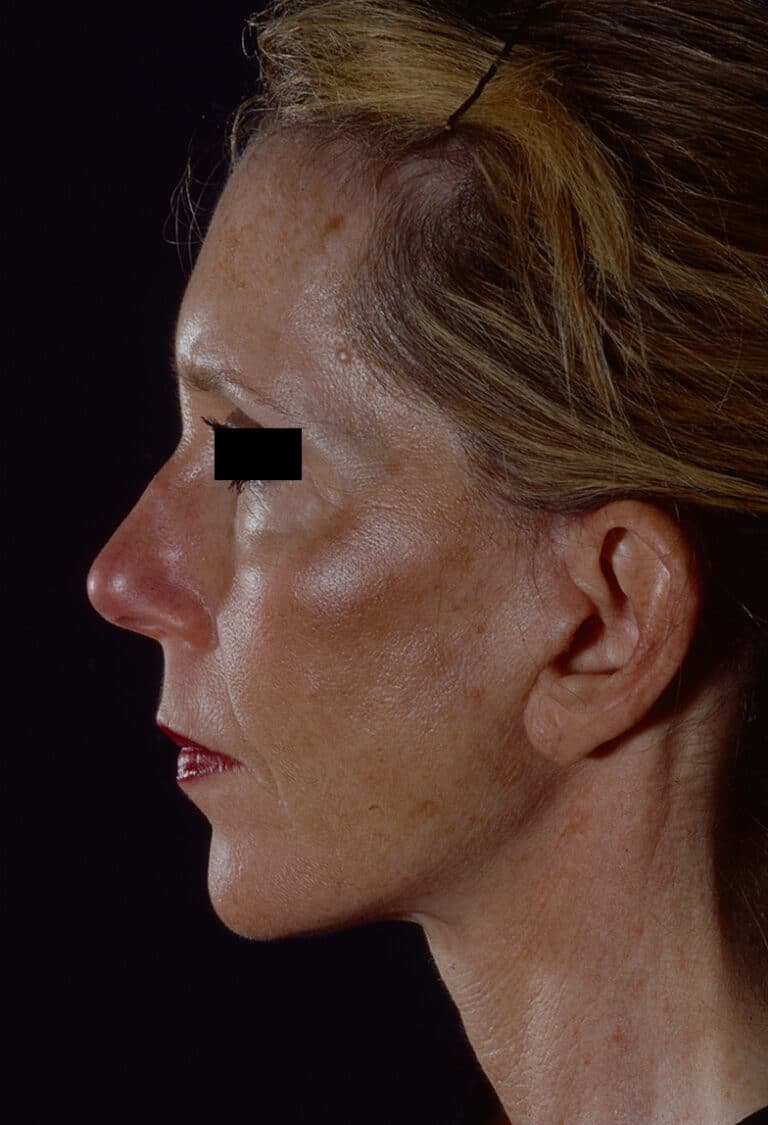 After Image: Facelift - left-side