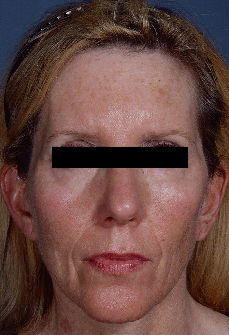 Before Image: Facelift - front