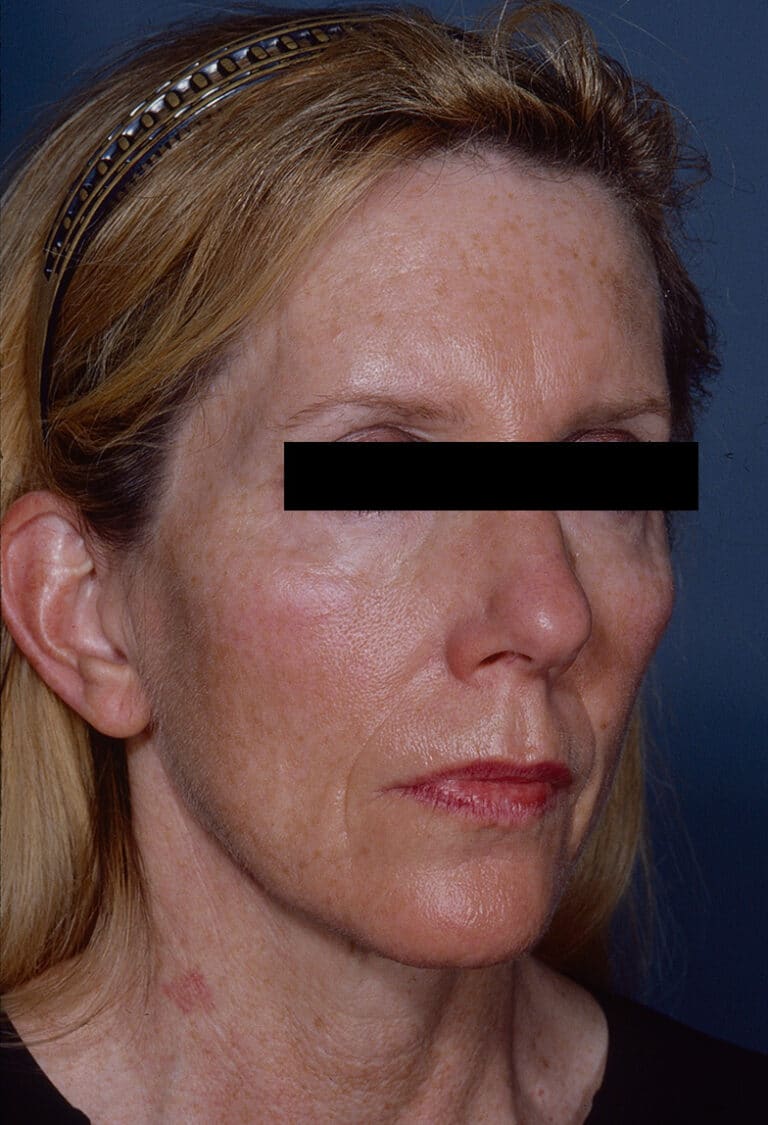 Before Image: Facelift - right-front-oblique