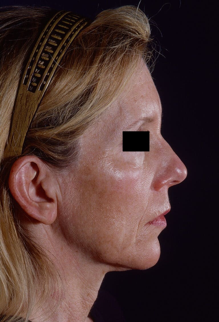 Before Image: Facelift - right-side