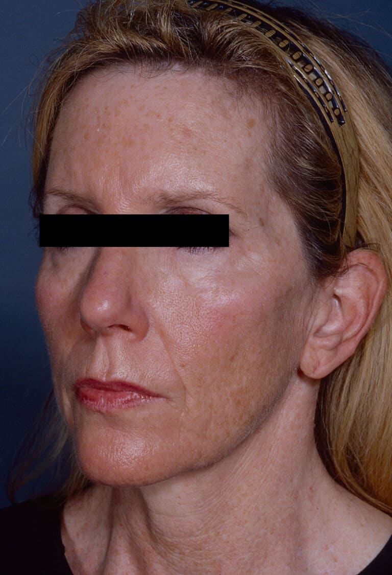 Before Image: Facelift - left-front-oblique