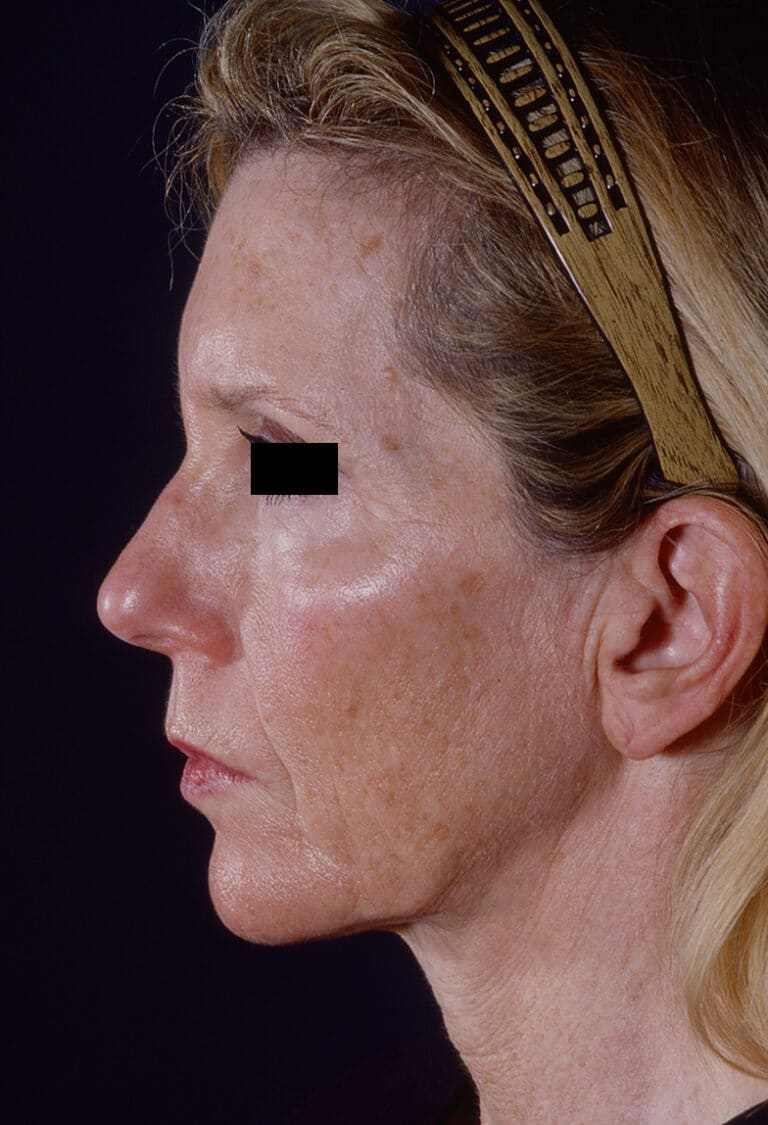 Before Image: Facelift - left-side