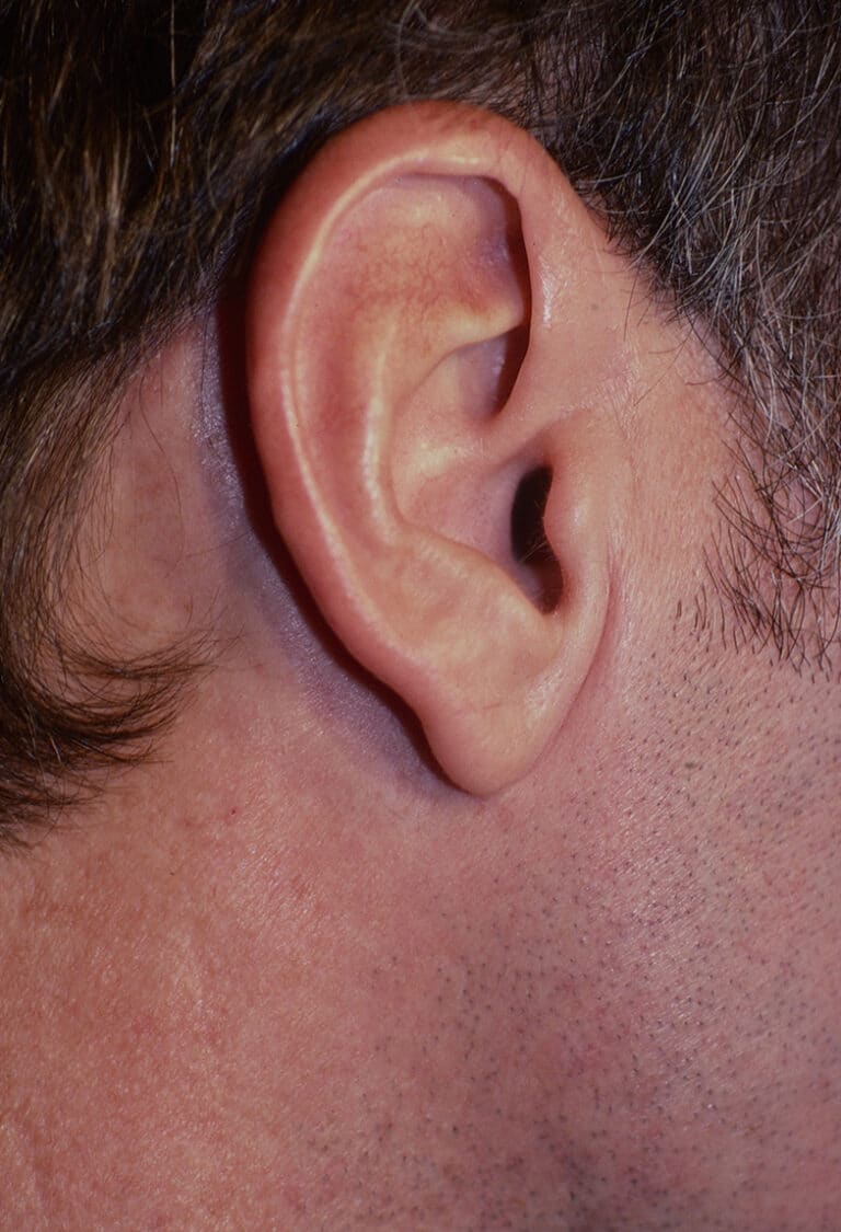 After Image: Facelift - right-side