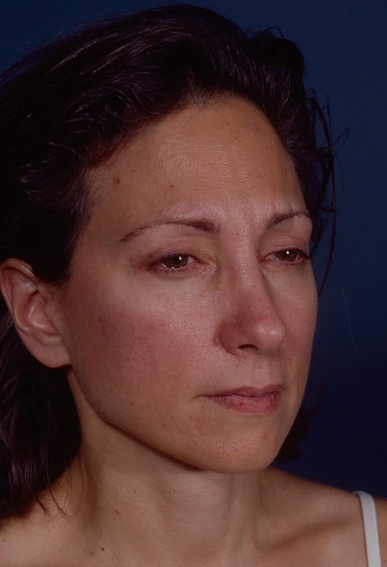 After Image: Blepharoplasty - right-front-oblique