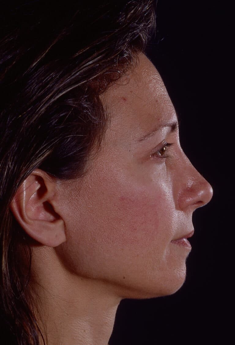 After Image: Blepharoplasty - right-side