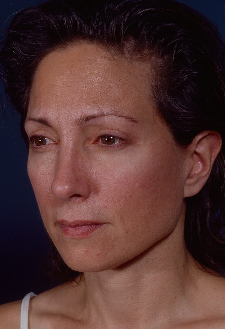 After Image: Blepharoplasty - left-front-oblique