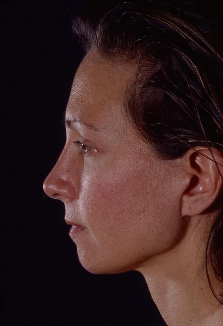 After Image: Blepharoplasty - left-side