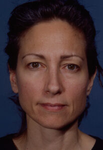 Before Image: Blepharoplasty