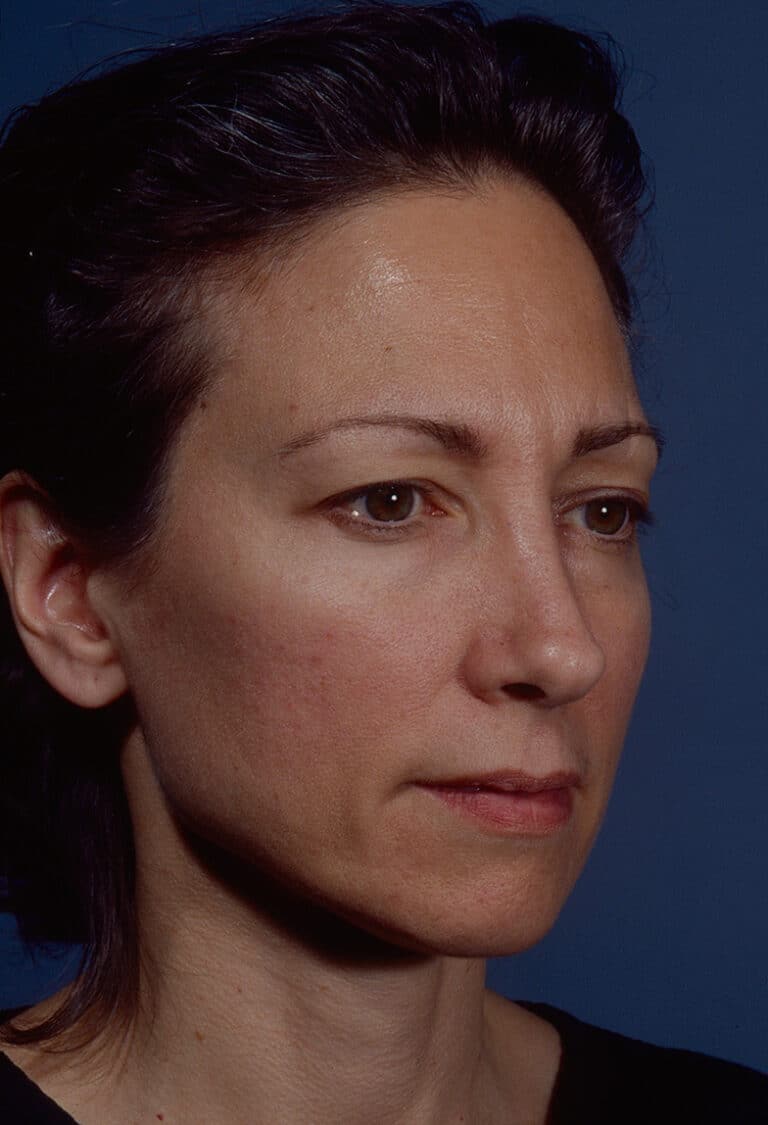 Before Image: Blepharoplasty - right-front-oblique