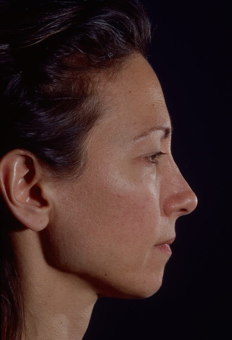 Before Image: Blepharoplasty - right-side