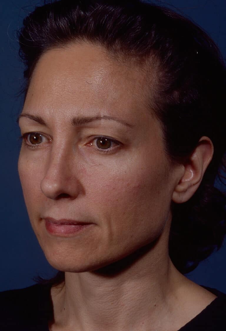 Before Image: Blepharoplasty - left-front-oblique