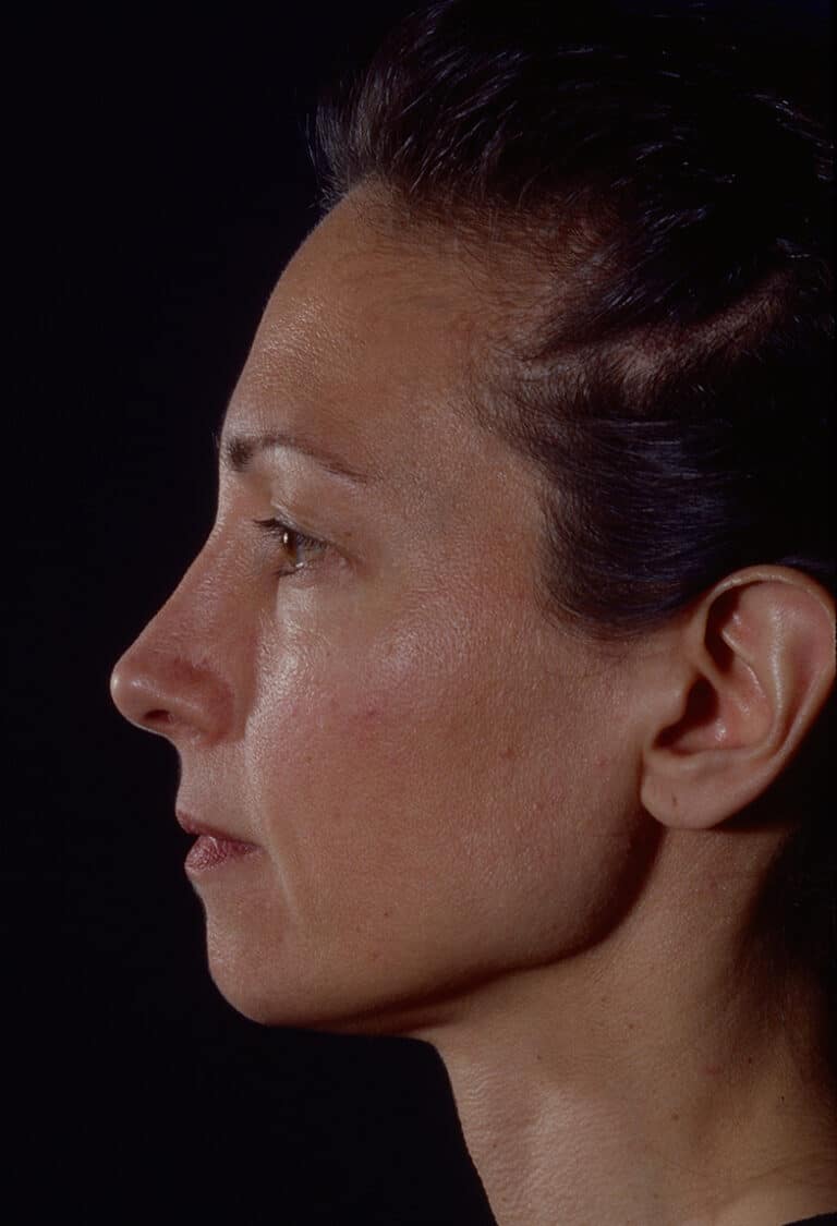 Before Image: Blepharoplasty - left-side