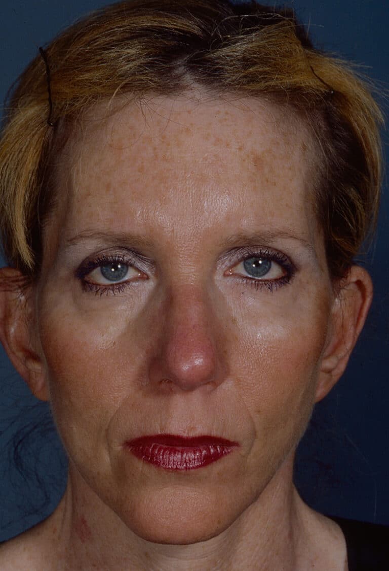 After Image: Blepharoplasty - front