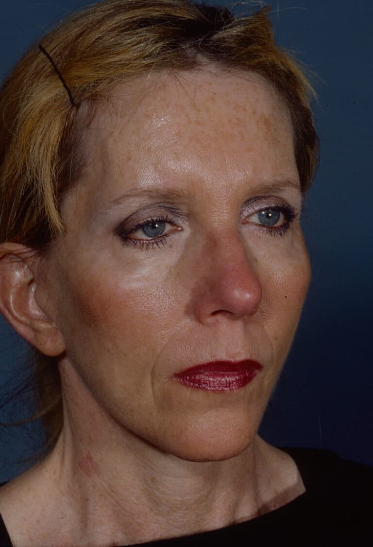 After Image: Blepharoplasty - right-front-oblique