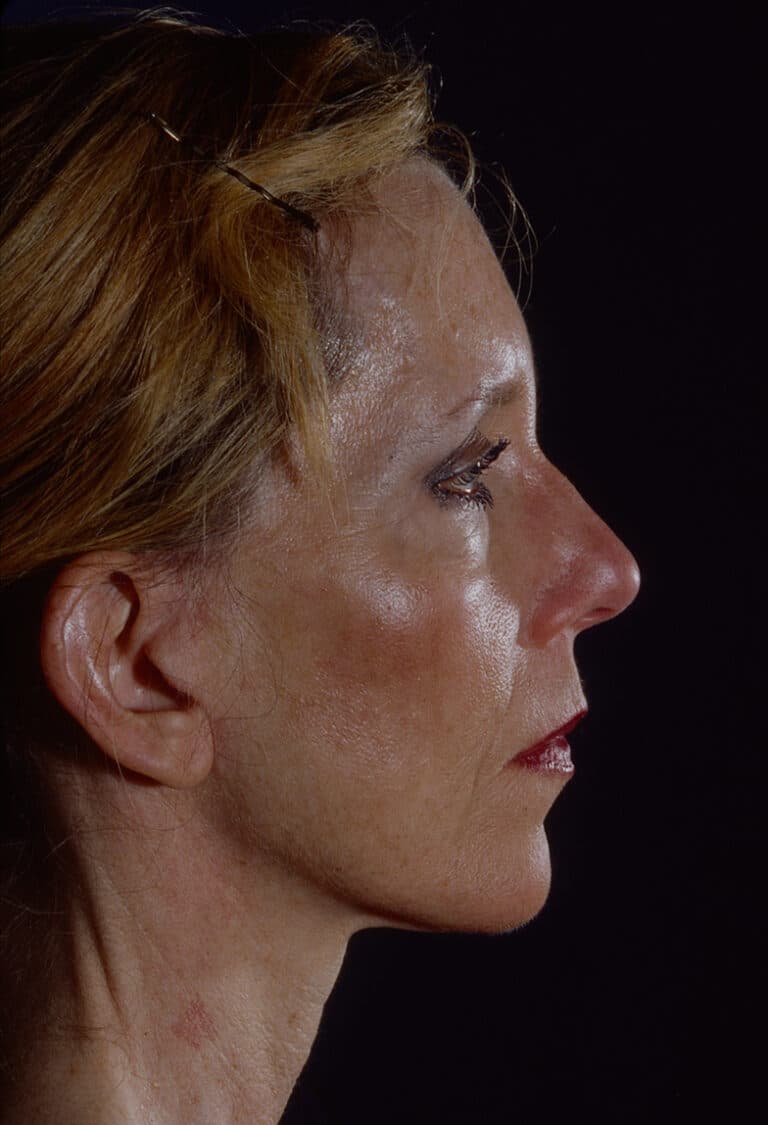 After Image: Blepharoplasty - right-side