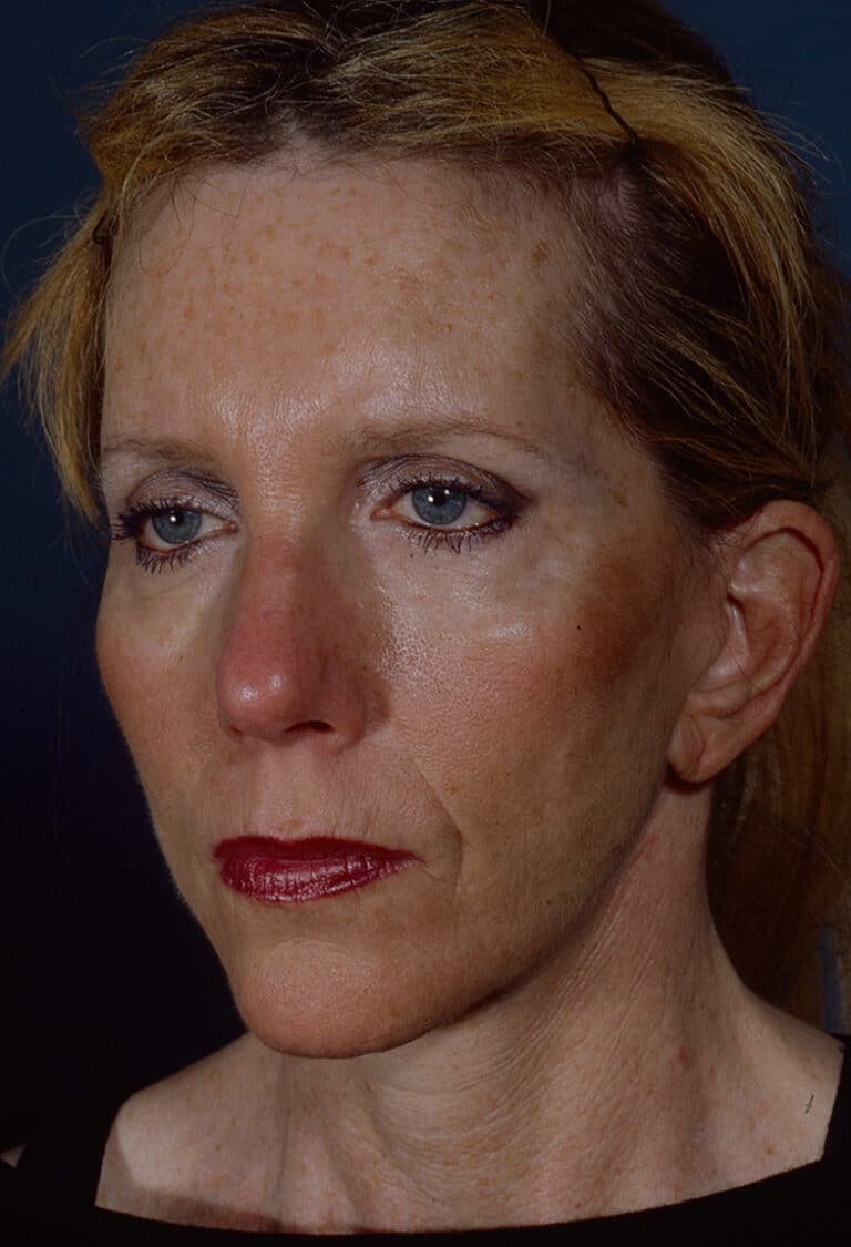 After Image: Blepharoplasty - left-front-oblique