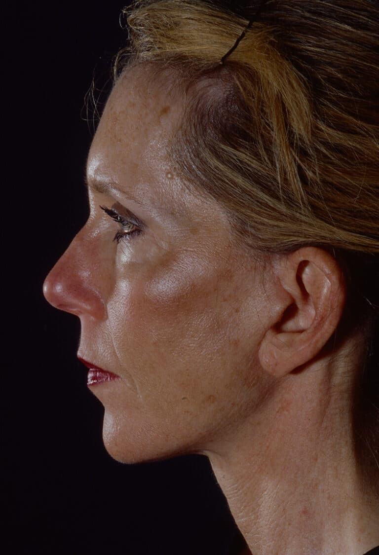 After Image: Blepharoplasty - left-side