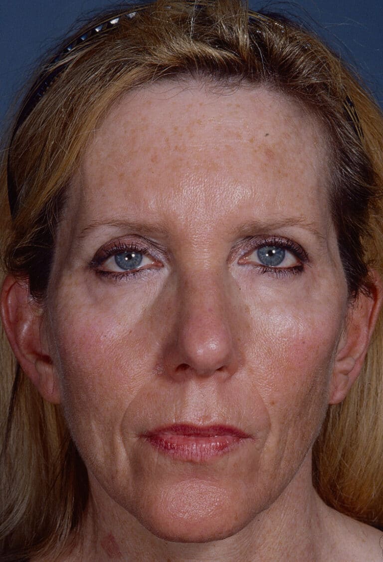 Before Image: Blepharoplasty - front