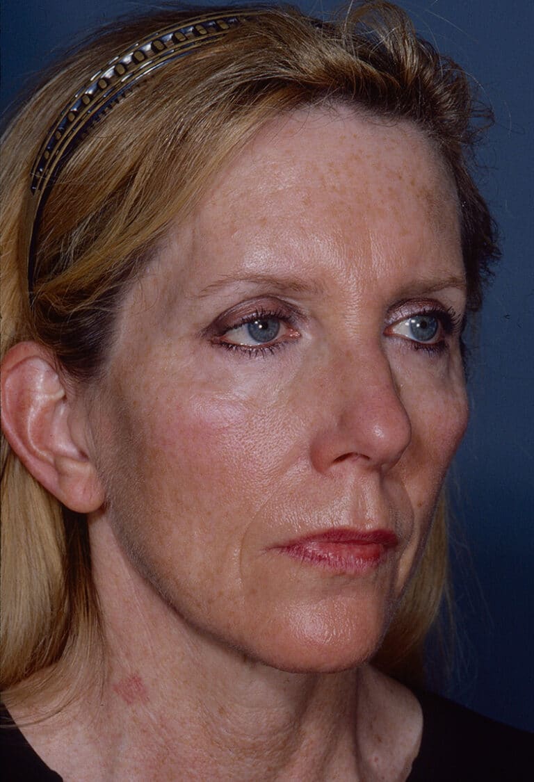 Before Image: Blepharoplasty - right-front-oblique
