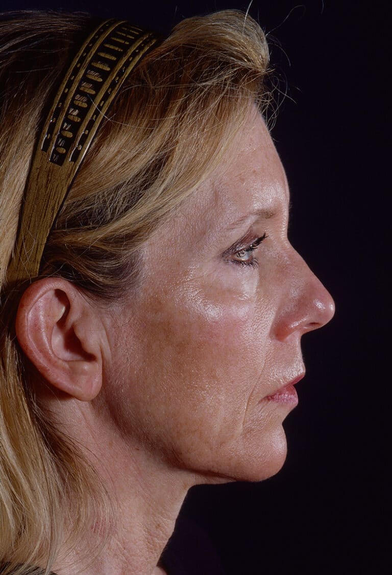 Before Image: Blepharoplasty - right-side