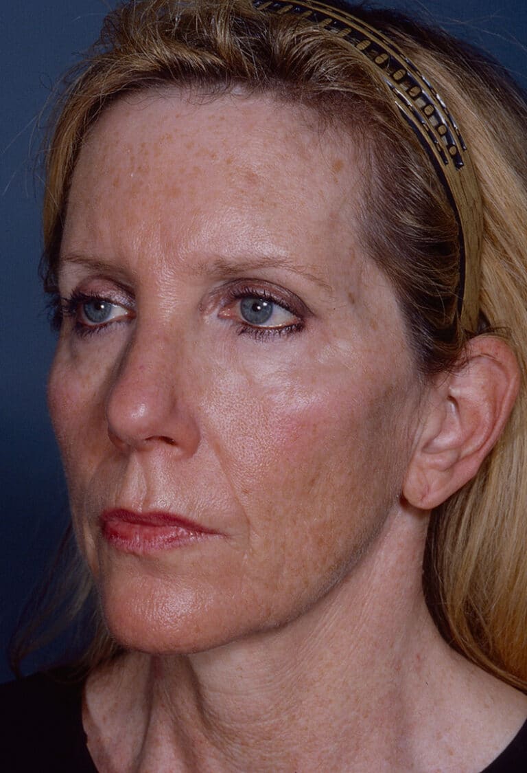 Before Image: Blepharoplasty - left-front-oblique