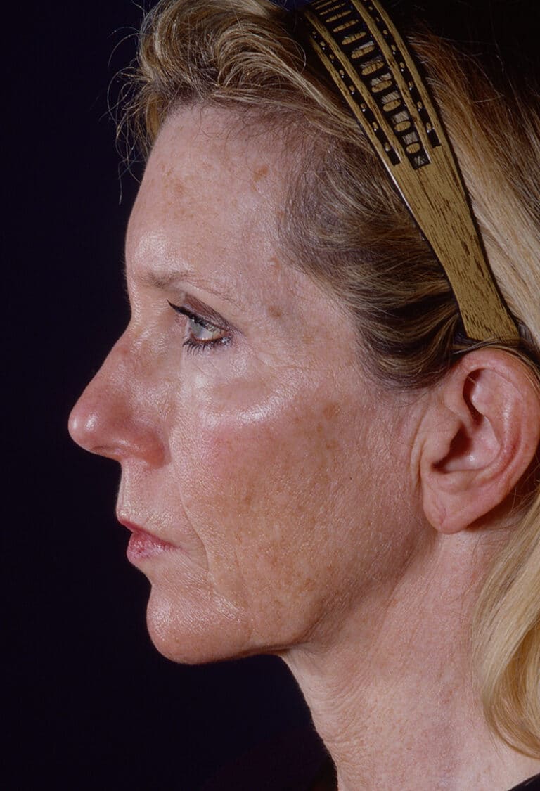 Before Image: Blepharoplasty - left-side