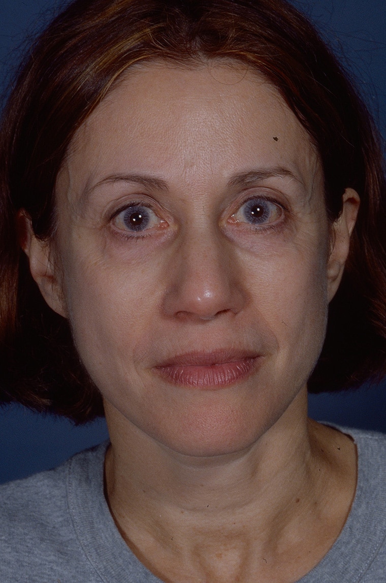 After Image: Blepharoplasty - front