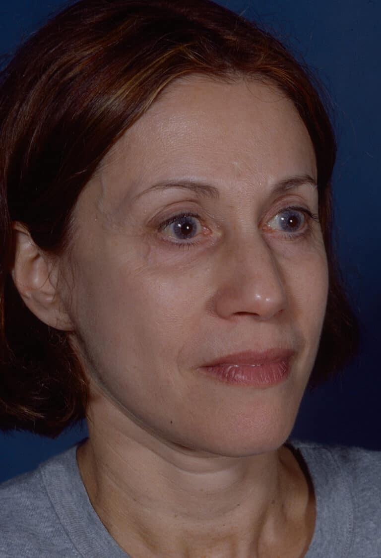 After Image: Blepharoplasty - right-front-oblique