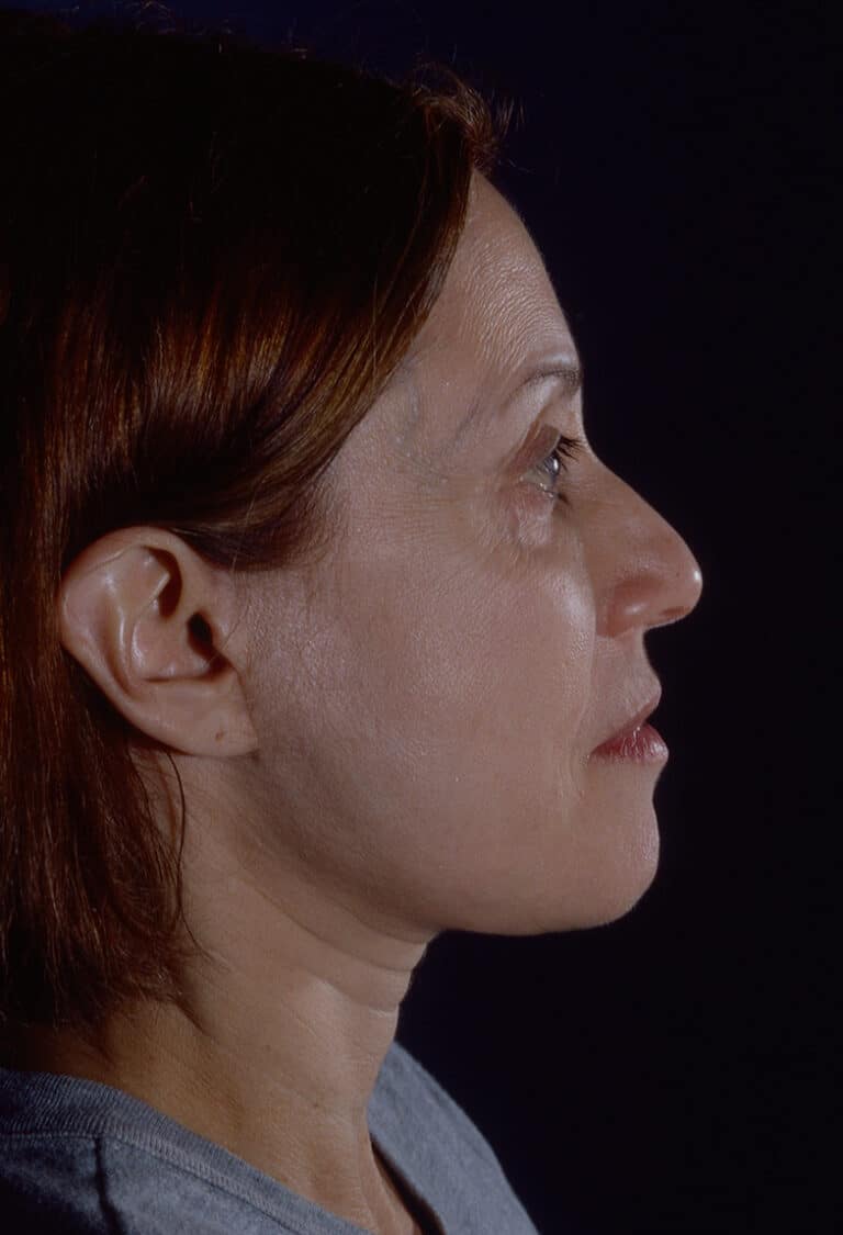 After Image: Blepharoplasty - right-side