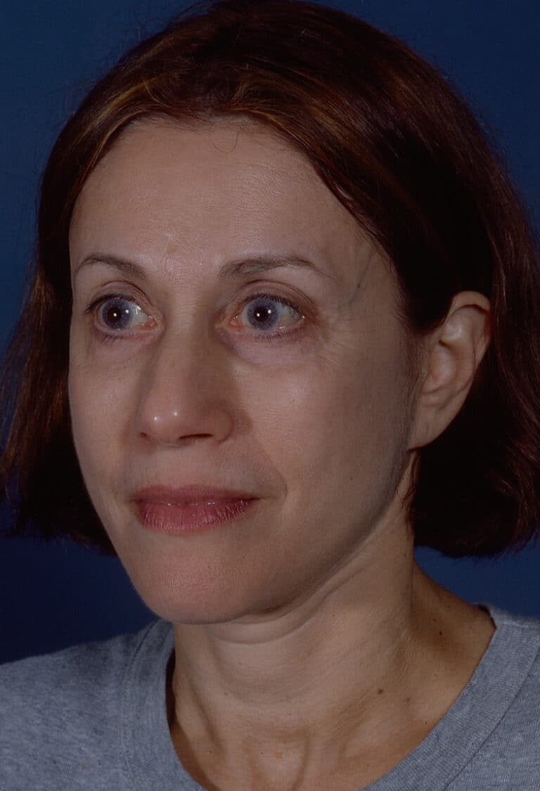 After Image: Blepharoplasty - left-front-oblique