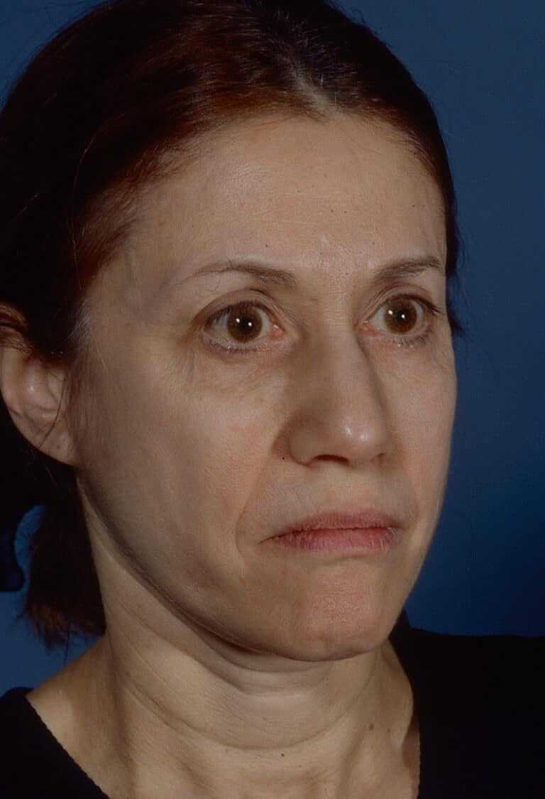 Before Image: Blepharoplasty - right-front-oblique