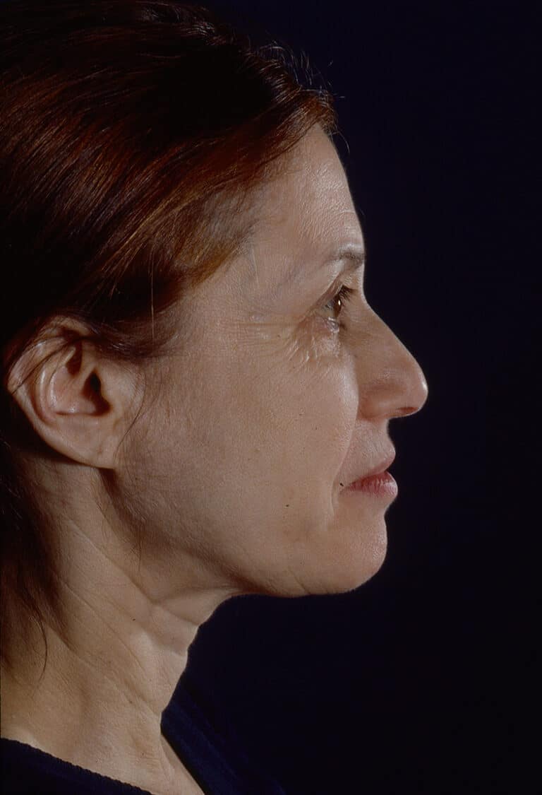 Before Image: Blepharoplasty - right-side