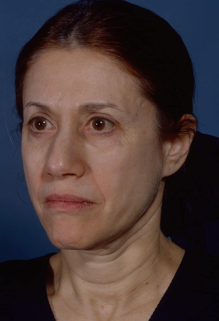 Before Image: Blepharoplasty - left-front-oblique