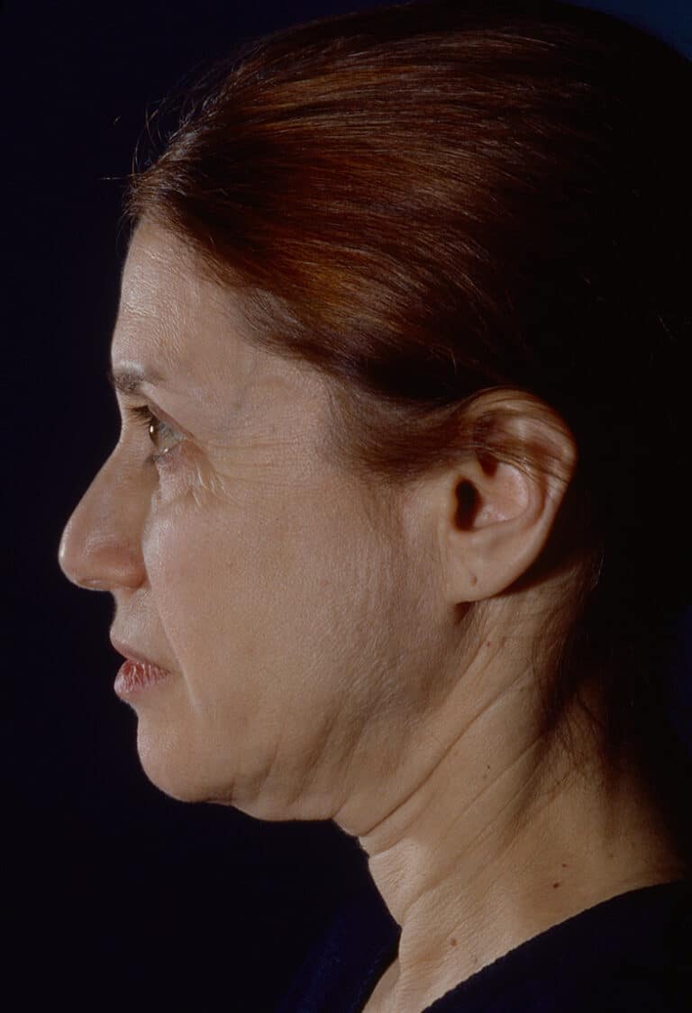 Before Image: Blepharoplasty - left-side