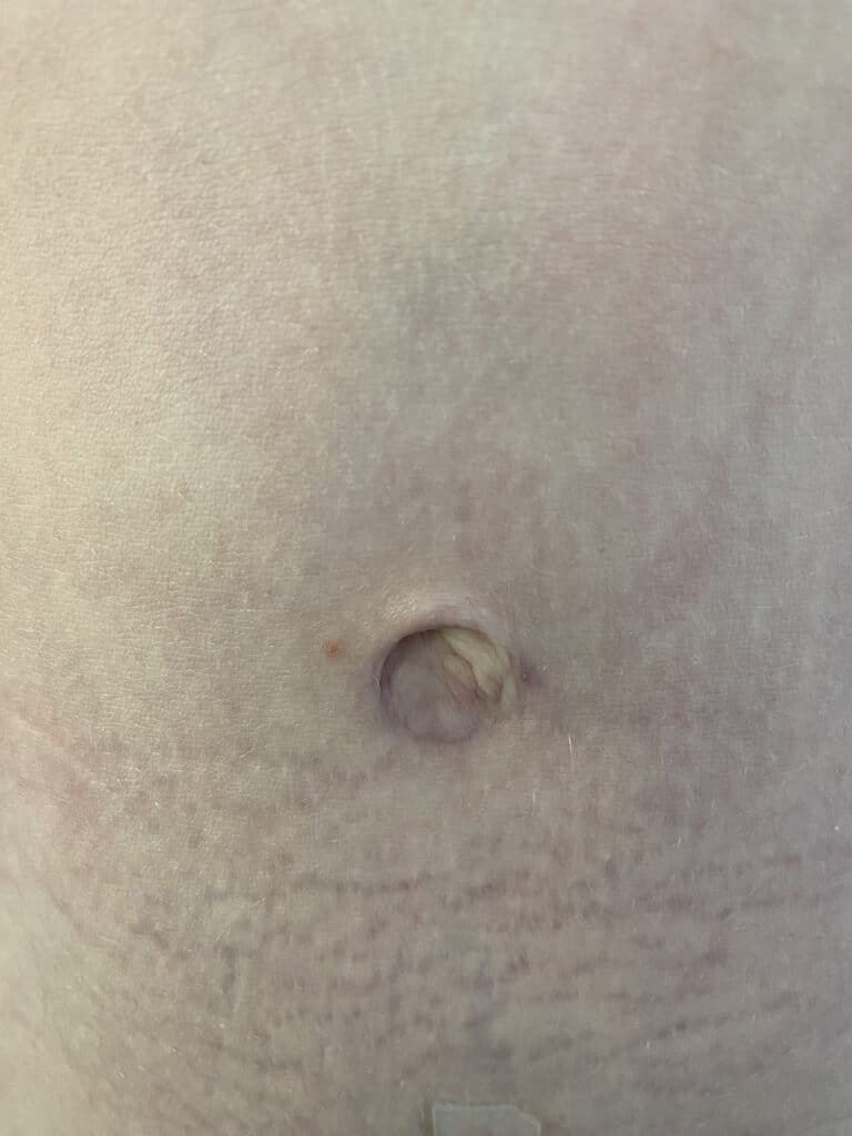 After Image: Post-Abdominoplasty Umbilicus - front