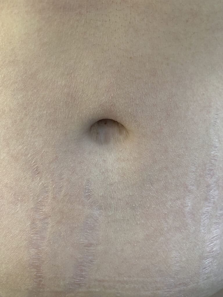 After Image: Post-Abdominoplasty Umbilicus - front