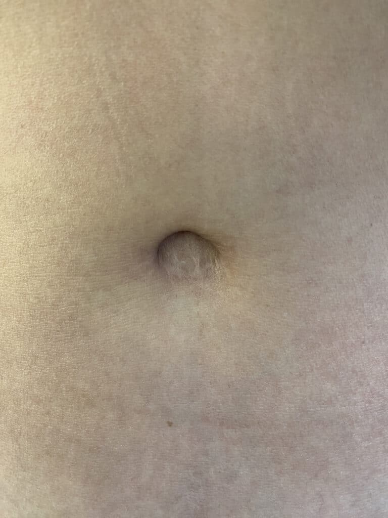 After Image: Post-Abdominoplasty Umbilicus - front