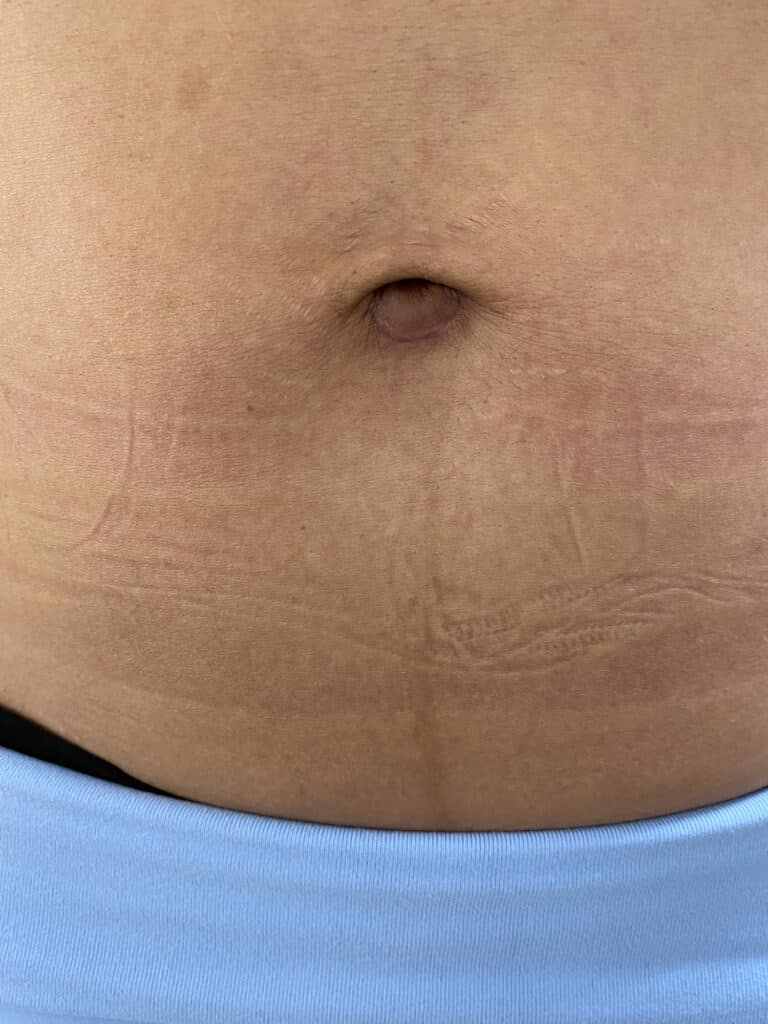 After Image: Post-Abdominoplasty Umbilicus - front