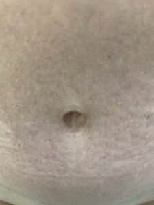 After Image: Post-Abdominoplasty Umbilicus