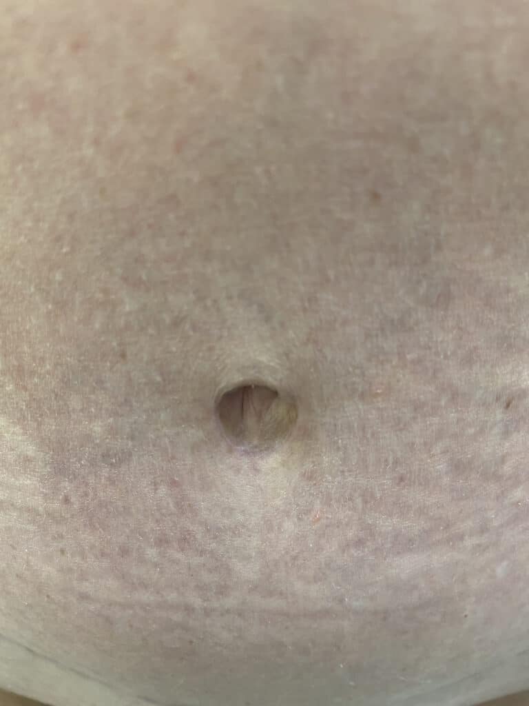 After Image: Post-Abdominoplasty Umbilicus - front