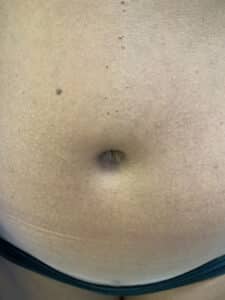 After Image: Post-Abdominoplasty Umbilicus